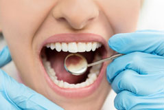 Adhesion Dental